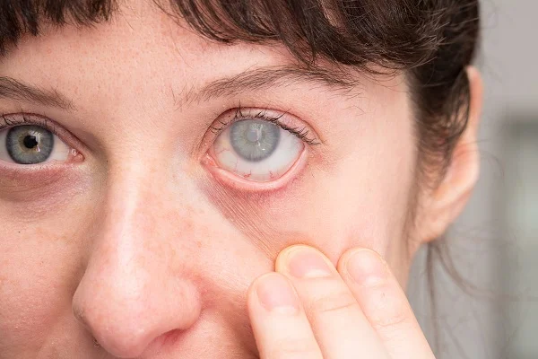 Glaucoma Surgery