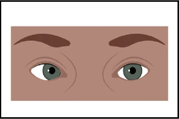 Accommodative Non Accommodative Esotropia