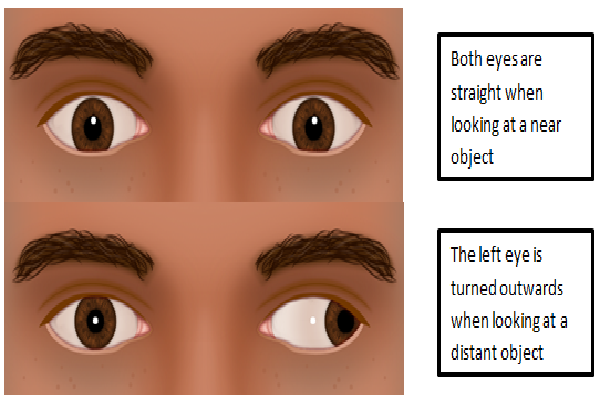 Secondary  Consecutive Exotropias