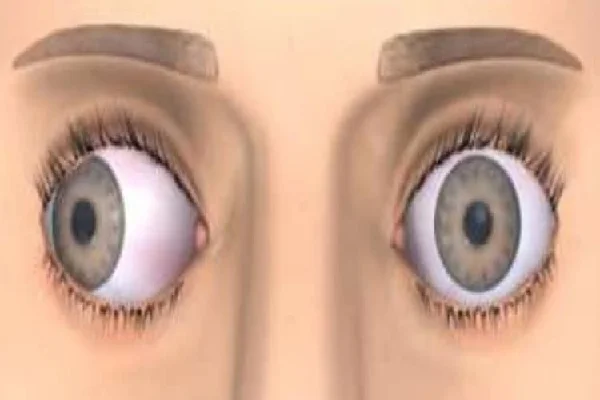 Superior Oblique Palsy